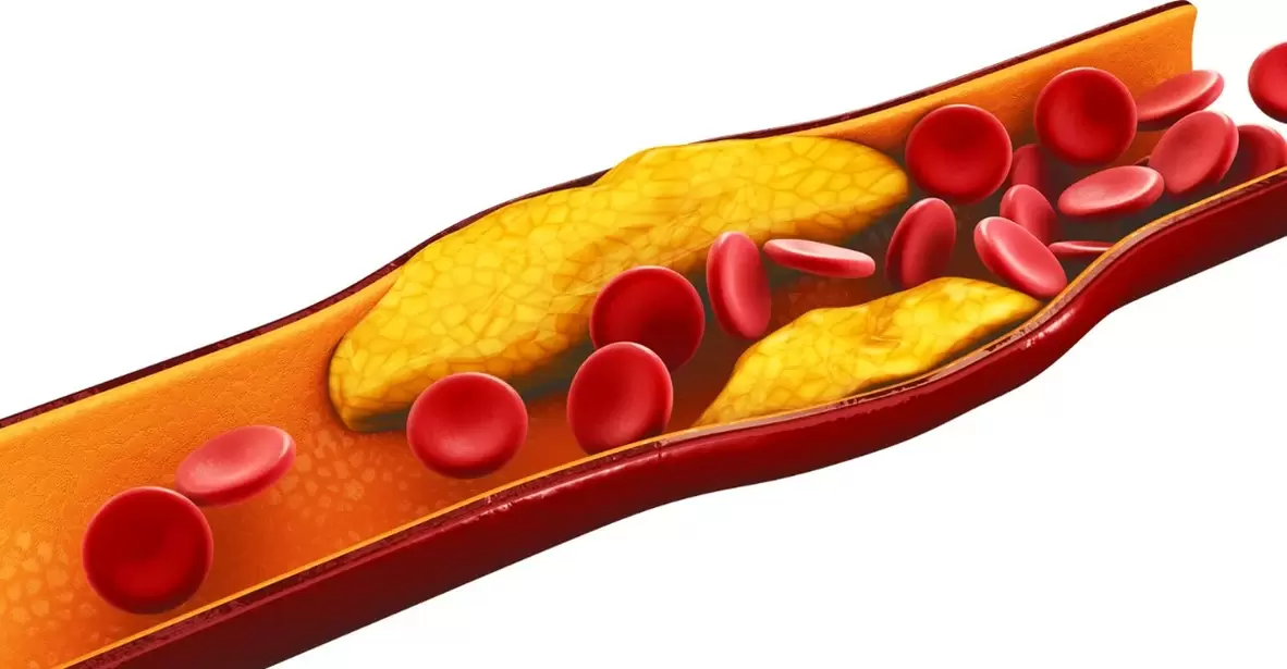 de Grond fir MiCardium Kapselen ze huelen ass vaskulär Atherosklerosis